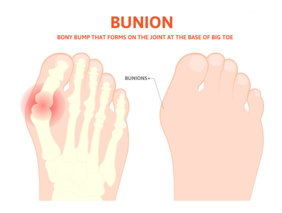 Foot Surgery for Bunions at an early stage is important for feet!