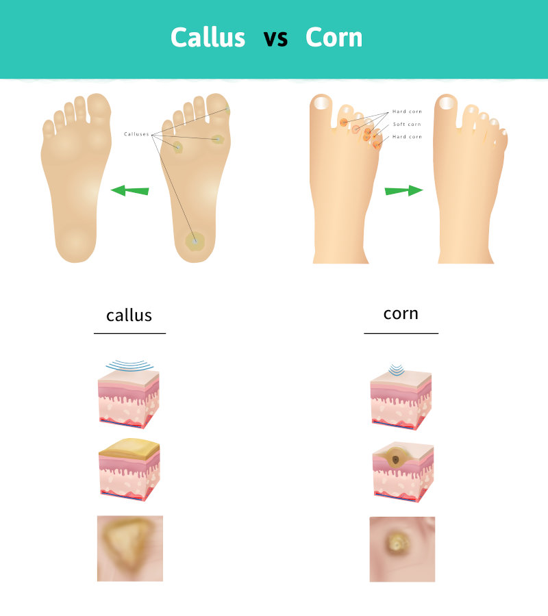 infographic of callus corn epidermal difference