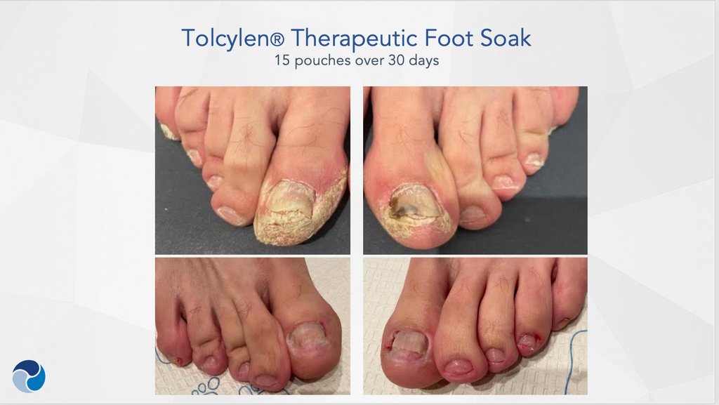 tolcylen-therapeutic-foot-soak-15pouches-30days