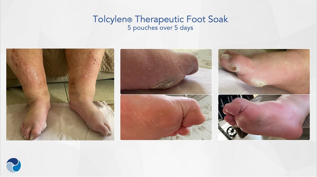 tolcylen-therapeutic-foot-soak-5pouches-5days-sideview
