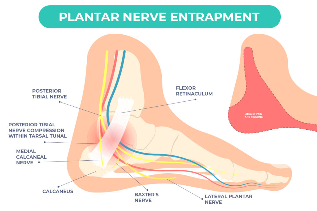 plantar-nerve entrapment inforgraphic of nerve layout