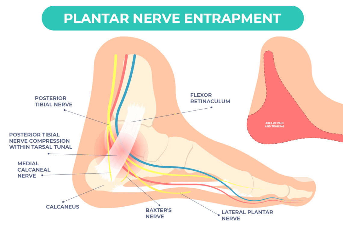 plantar-nerve-entrapment-could-be-the-cause-of-your-heel-pain