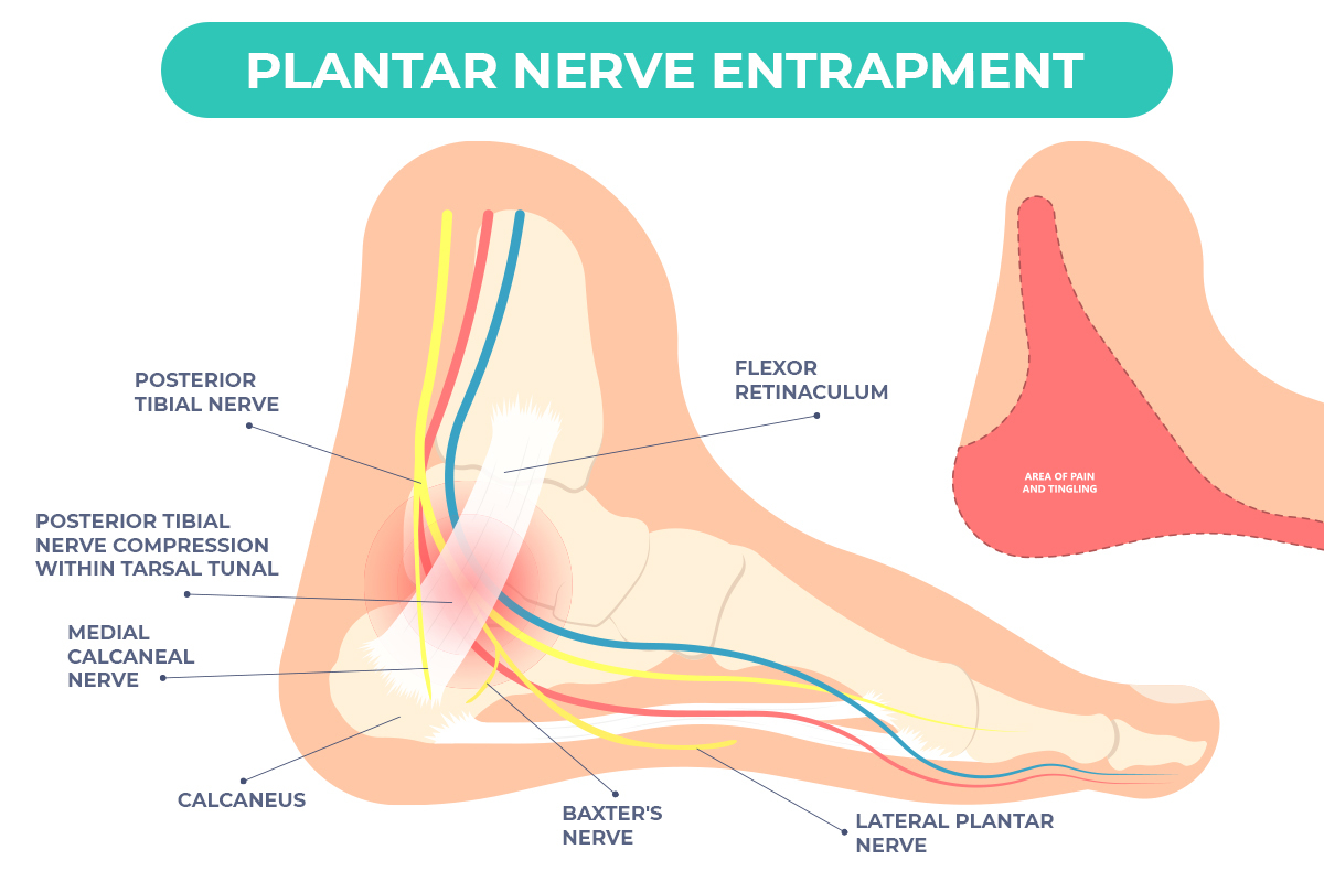 Plantar Nerve Entrapment could be the cause of your heel pain!
