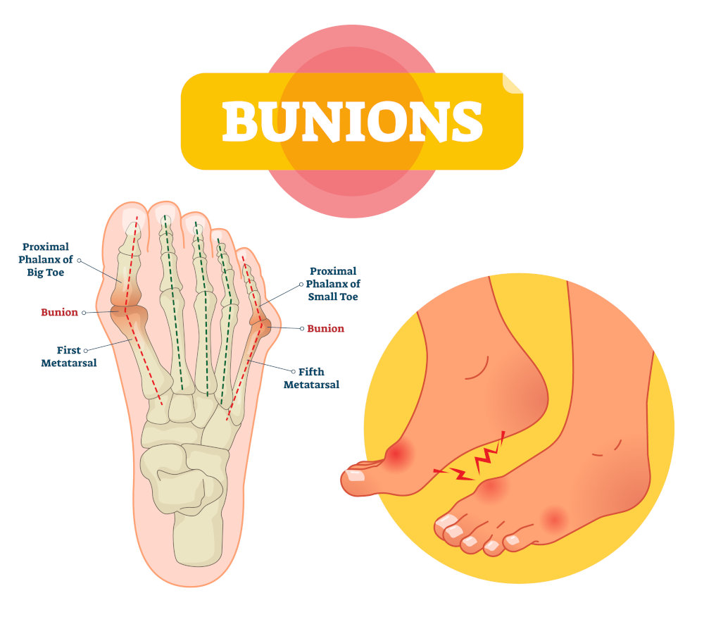 bunions-infographic