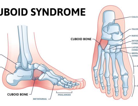 Cuboid Syndrome treatment