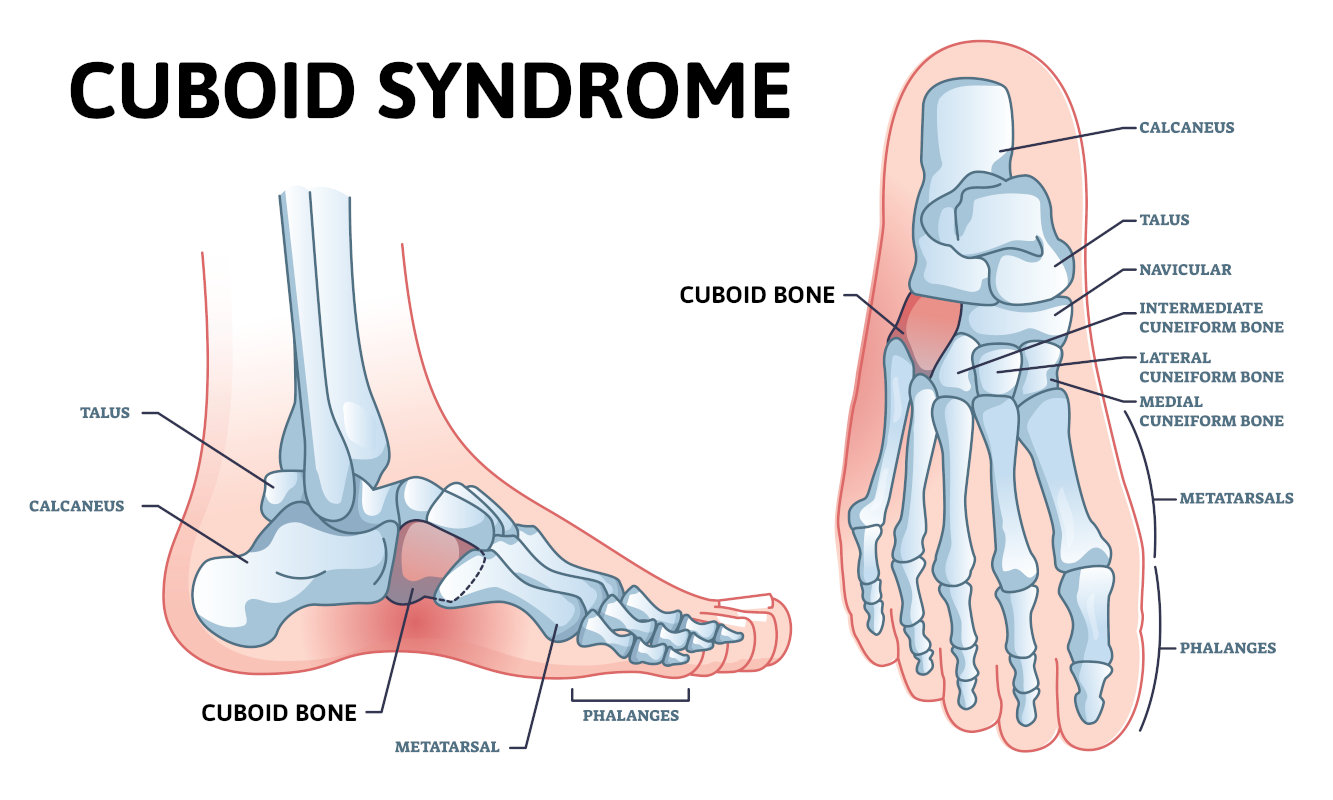 Heel Fat Pad Syndrome: Symptoms, Causes & Treatment
