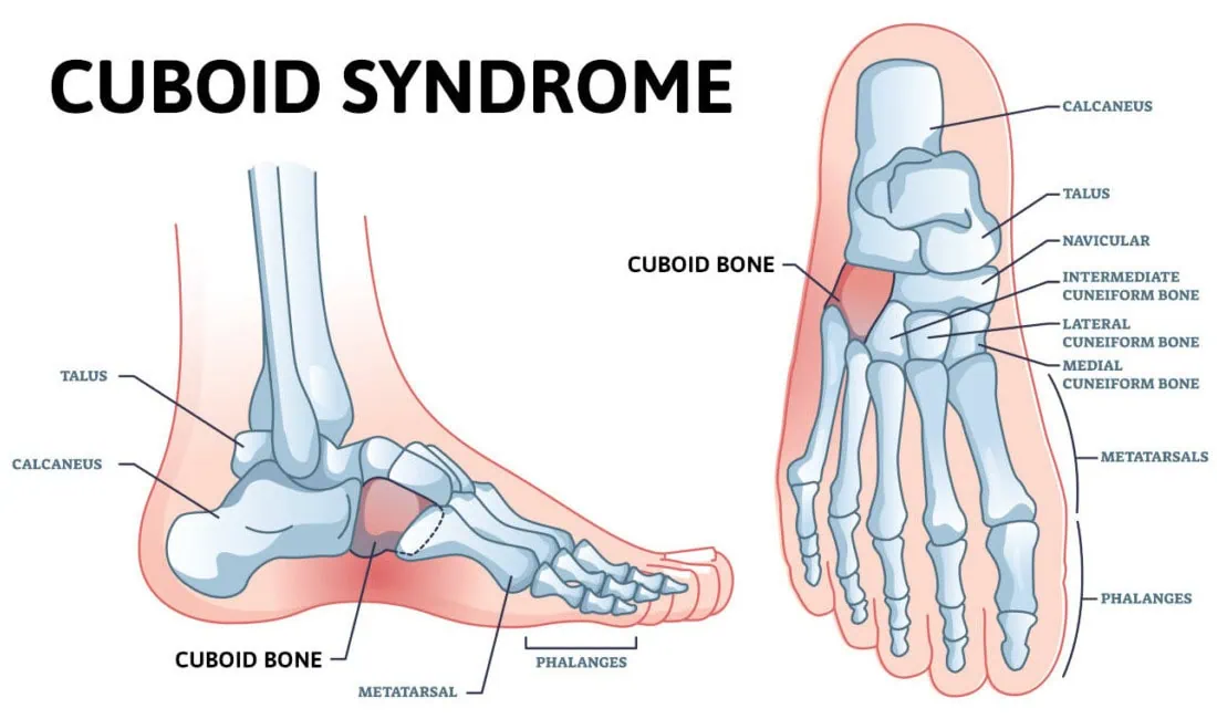 Cuboid Syndrome treatment