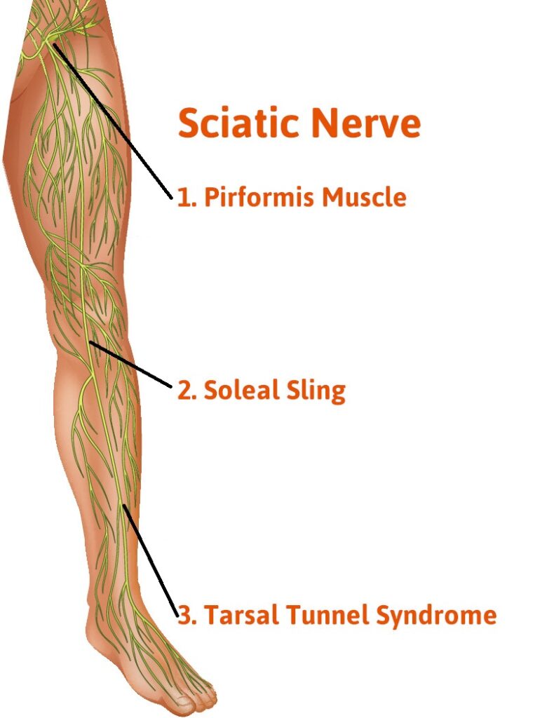 Posterior Tibial Nerve-Issues Infographic Three Potential Areas of Nerve Compression