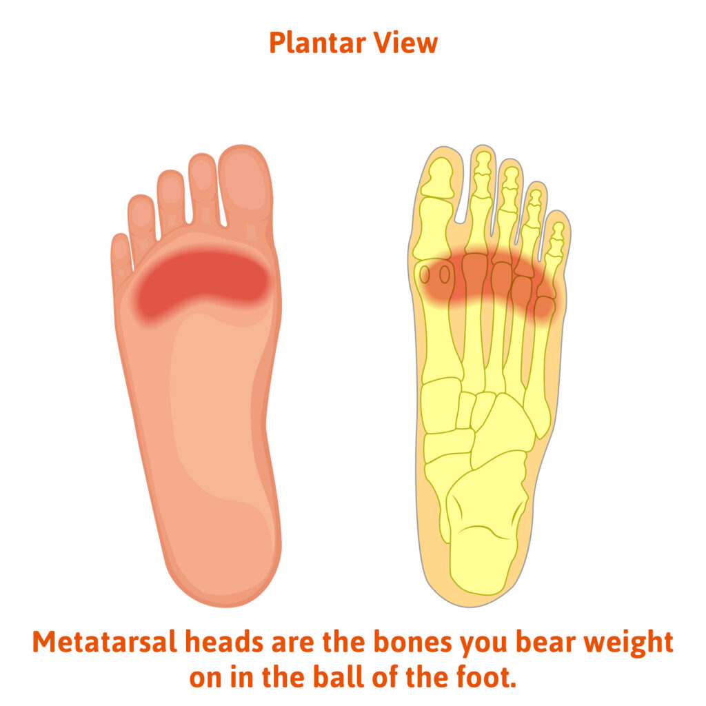 Freiberg’s disease is an often overlooked foot issue!