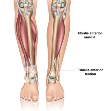 Muscles and tendons tibialis anterior tendonitis