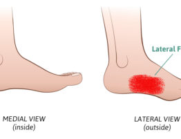 lateral foot pain