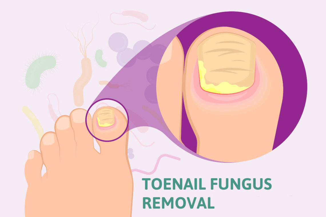 toenail fungus removal