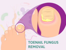 toenail fungus removal