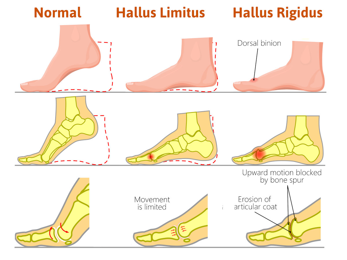 Big Toe Pain hallux limitus