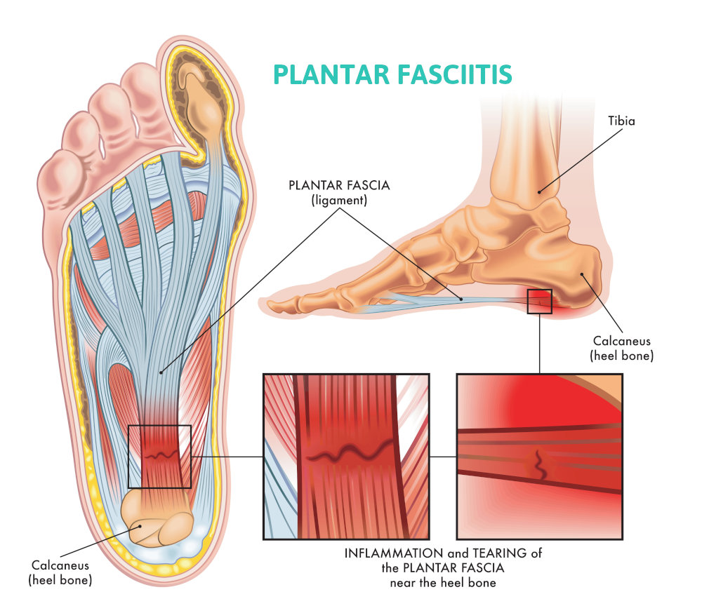 plantar fasciitis infographic