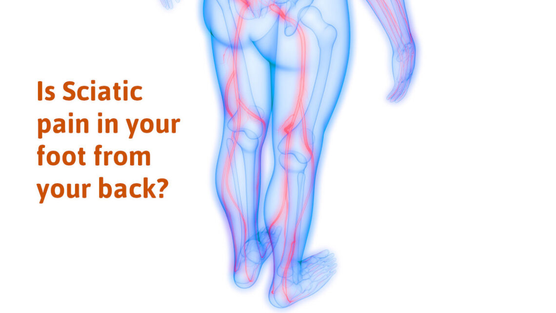 sciatica foot pain