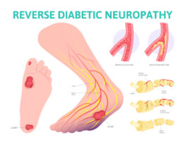 treatment for diabetic neuropathy