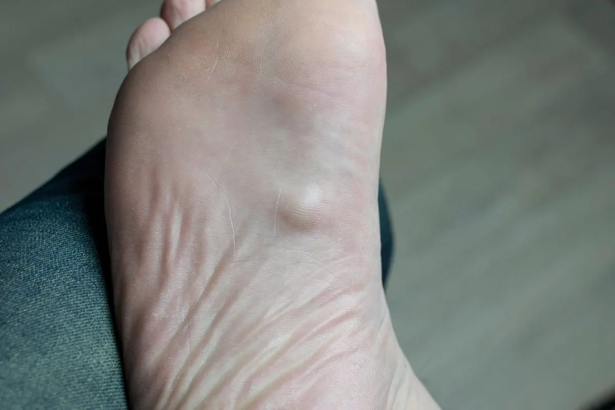 Plantar Fascial Fibromatosis Ledderhose Disease