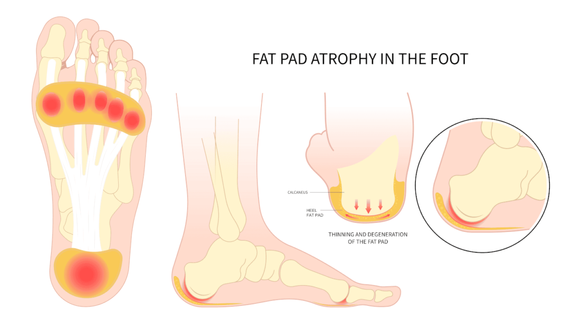 heel pad syndrome