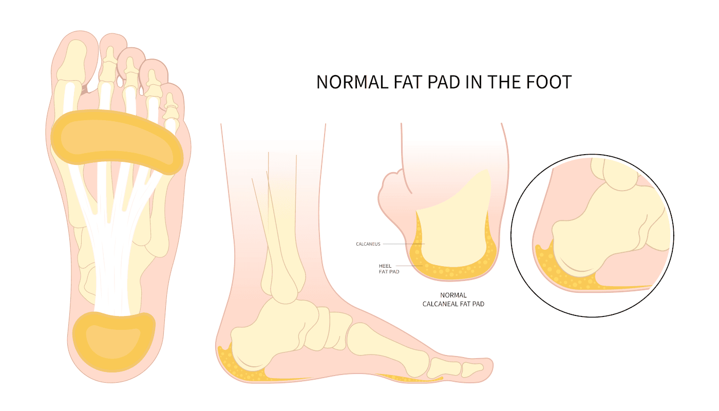 heel pad normal foot