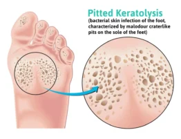 pitted keratolysis