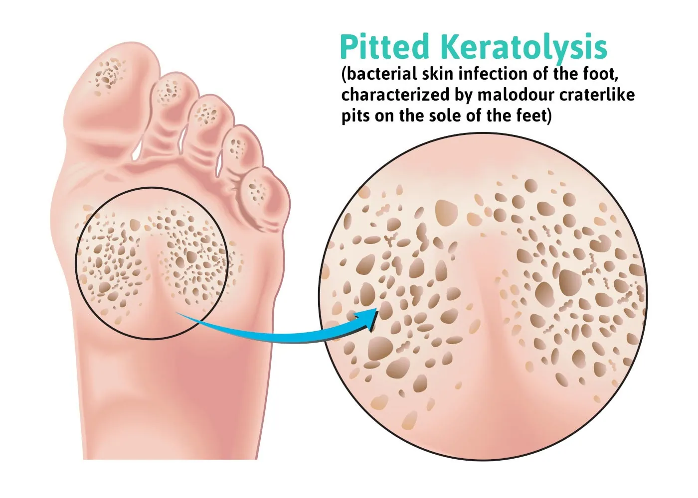 pitted keratolysis