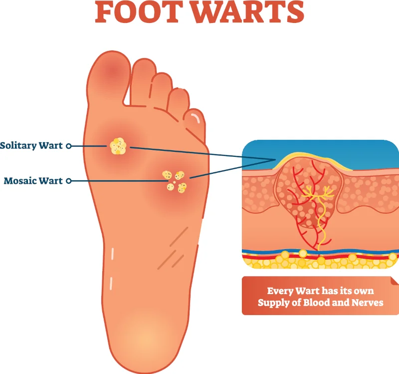 plantar-warts-infographic