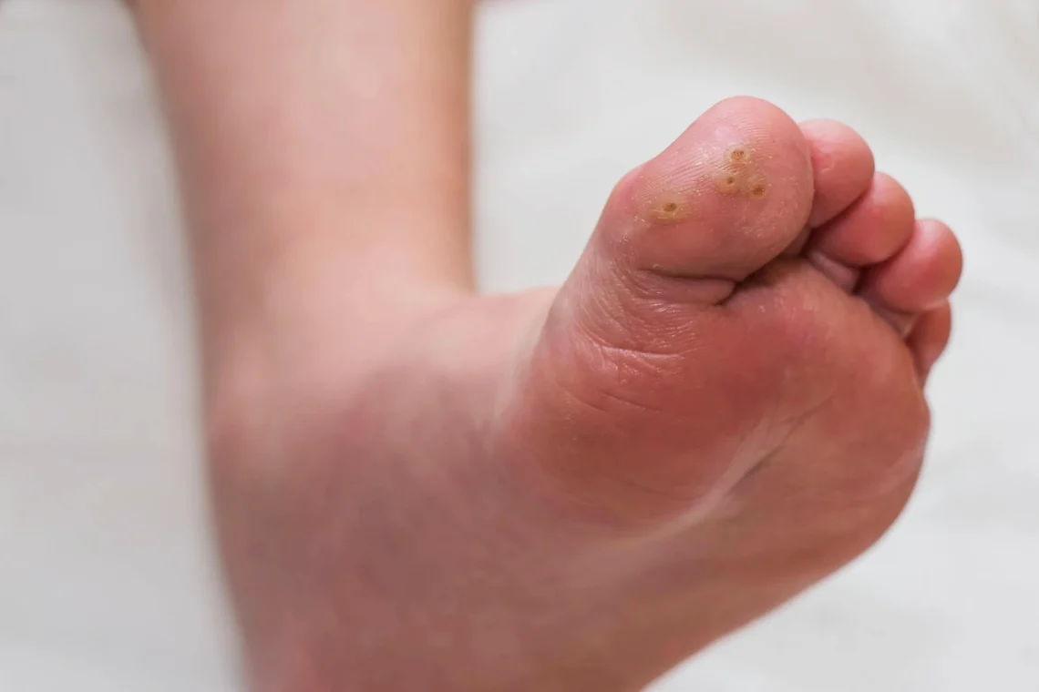 what are the causes of plantar warts