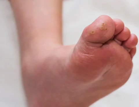 what are the causes of plantar warts