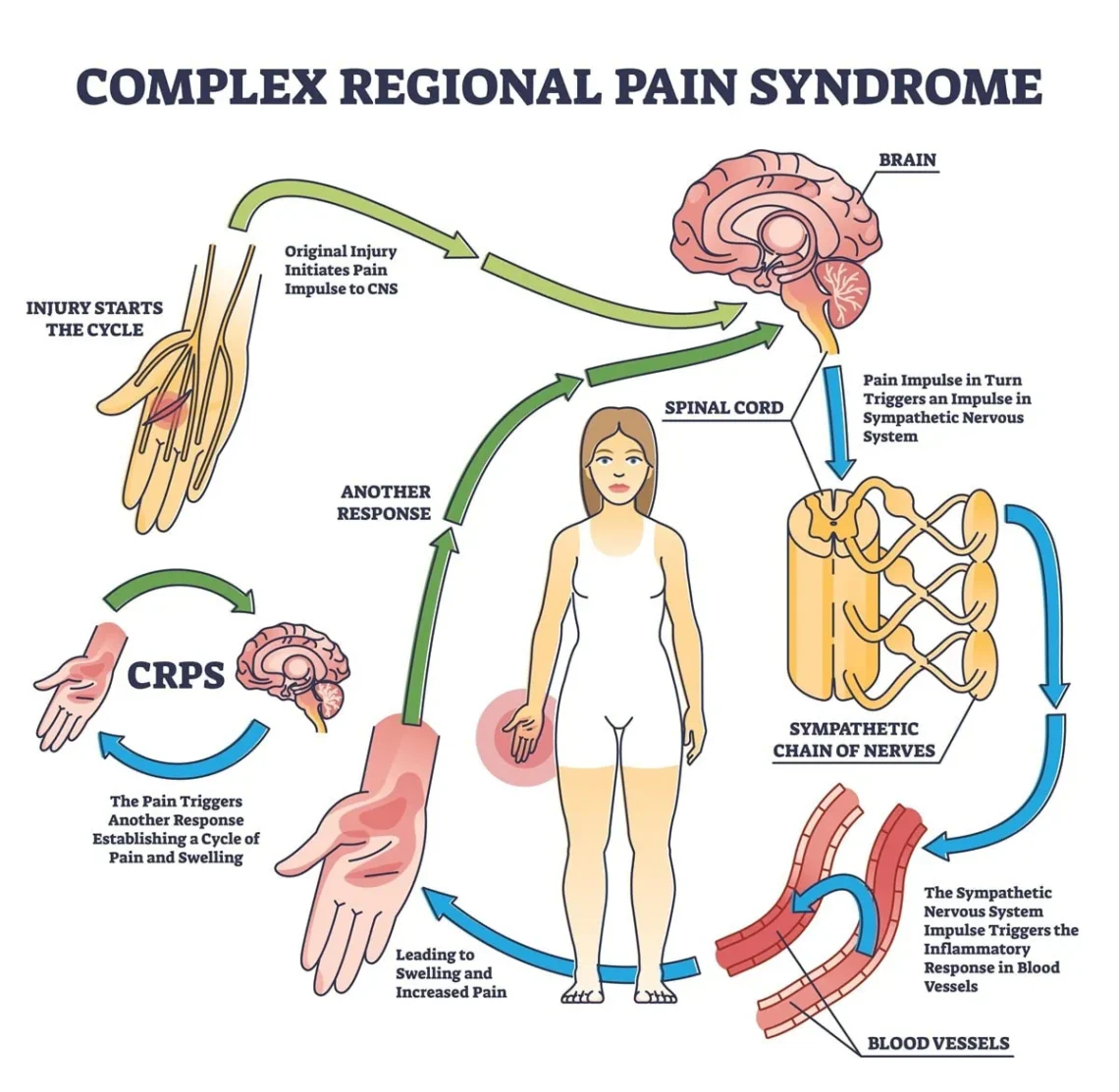 Complex Regional Pain Syndrome CRPS