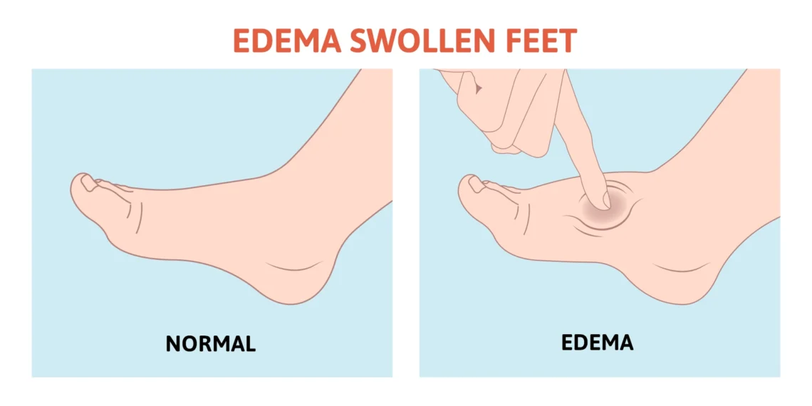 edema in legs