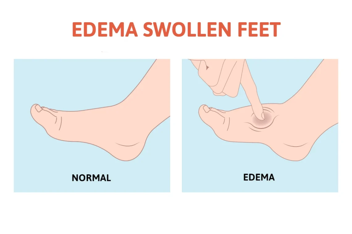 edema in legs