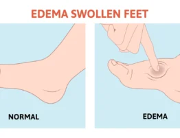 edema in legs