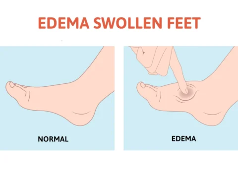 edema in legs