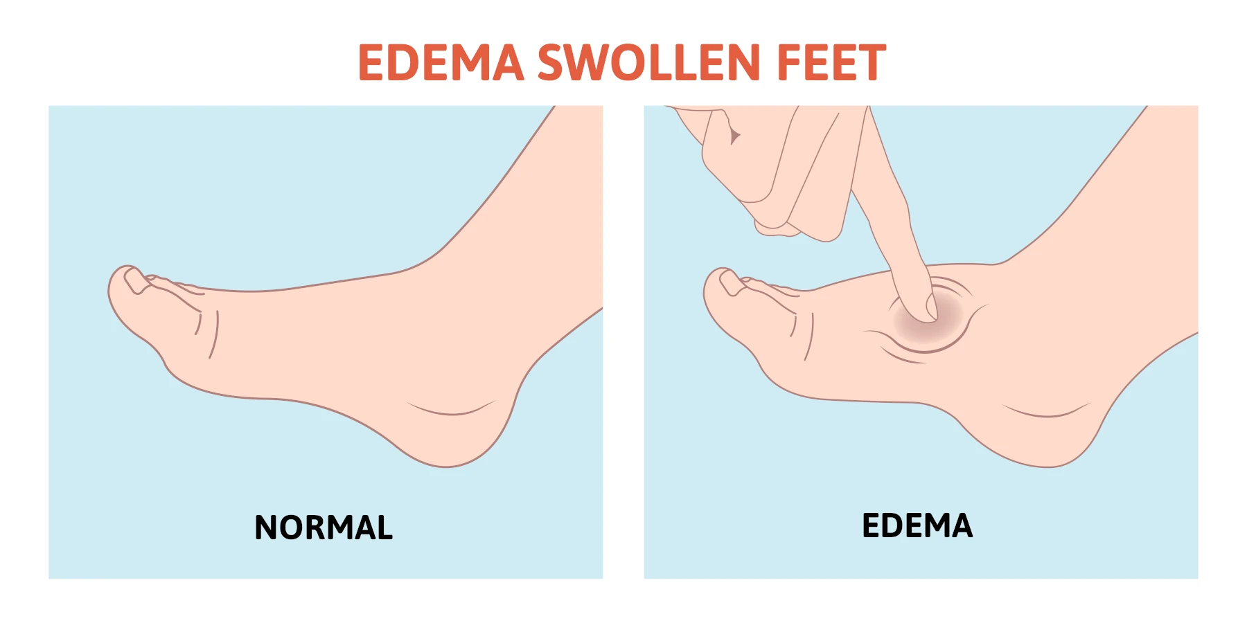 edema in legs