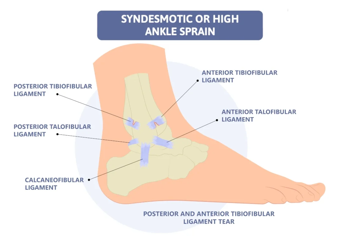 syndesmotic ankle sprain