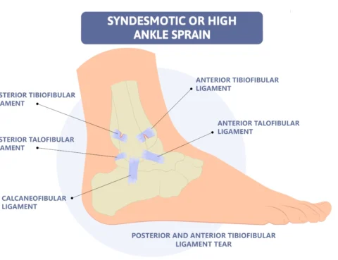 syndesmotic ankle sprain