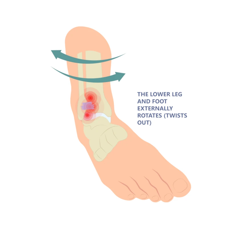 syndesmotic high ankle sprain