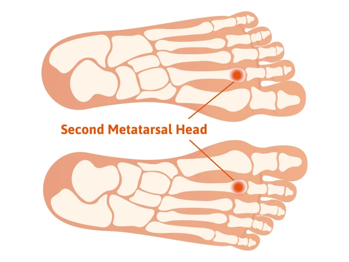 Freibergs disease second metatarsal head