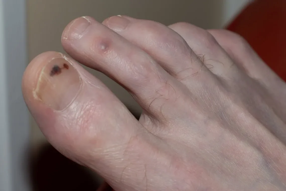 black spot on toenail