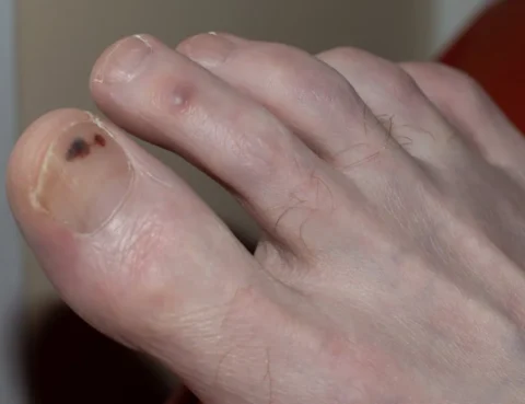 black spot on toenail