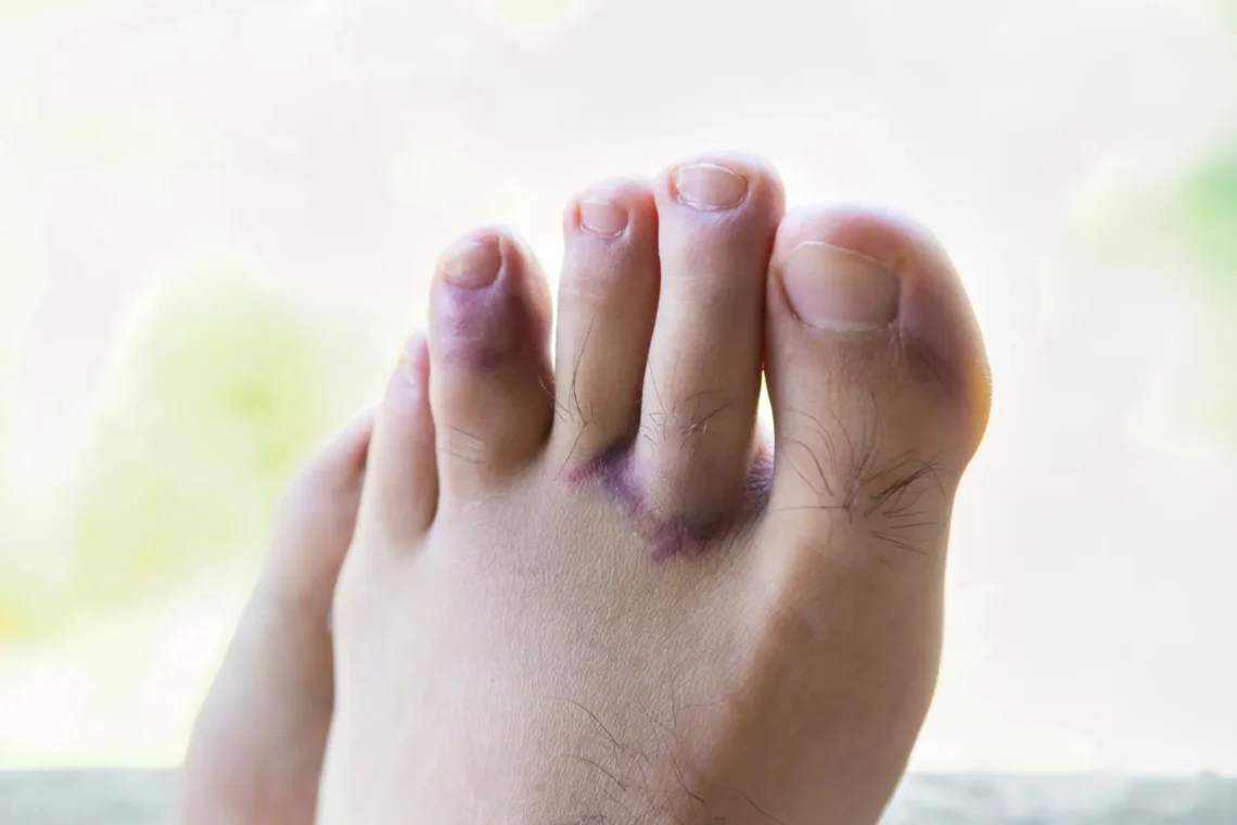 how to know if toe is broken