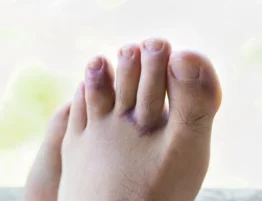 how to know if toe is broken