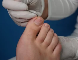 how to fix ingrown toenail permanently