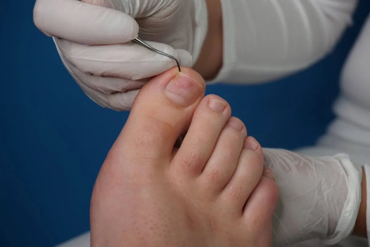 how to fix ingrown toenail permanently