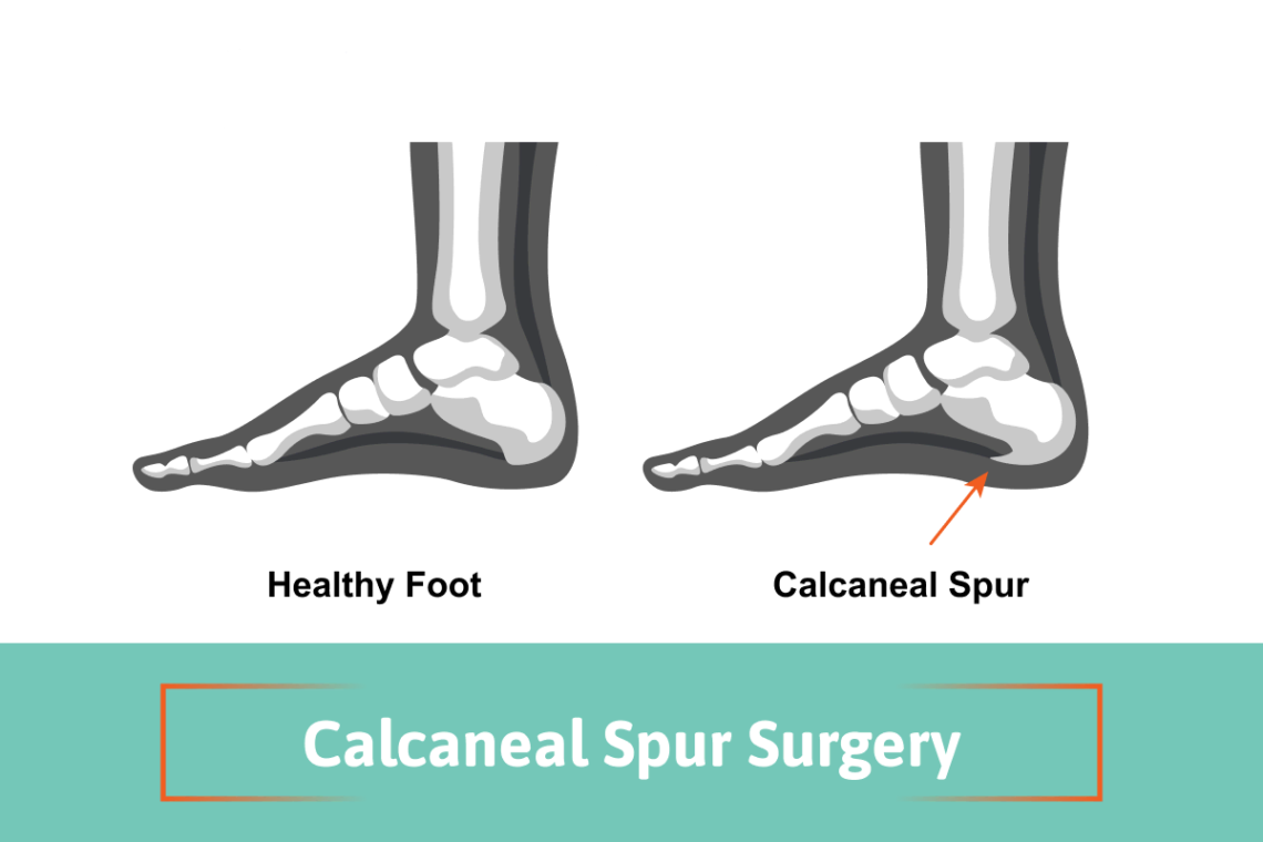 calcaneal spur surgery
