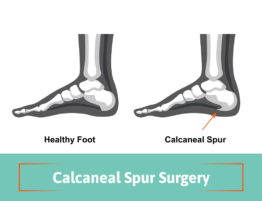 calcaneal spur surgery
