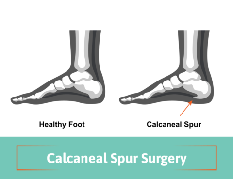 calcaneal spur surgery