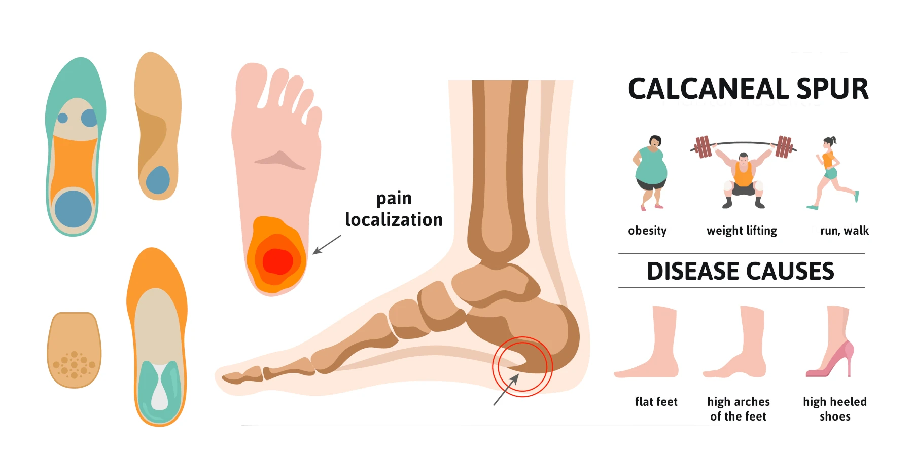 calcaneal spur surgery causes infographic