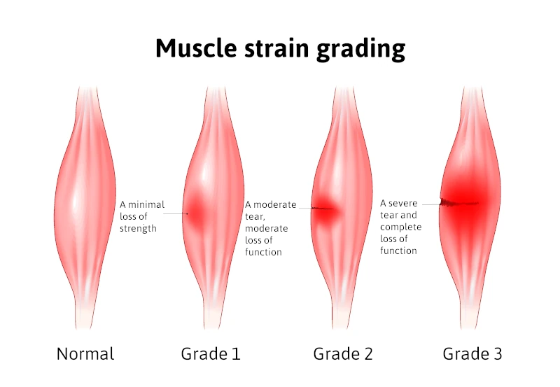 Grades of Muscle Strain In Leg Infographic